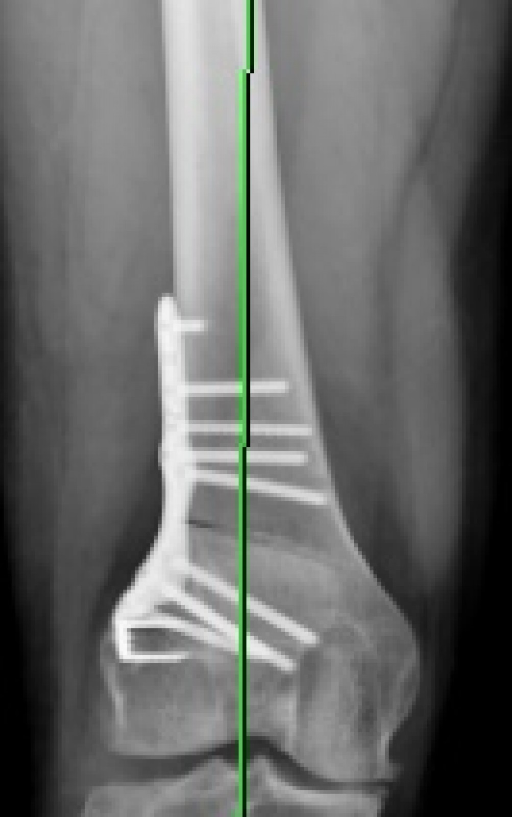 l’ostéotomie fémorale : tout savoir sur cette intervention  !