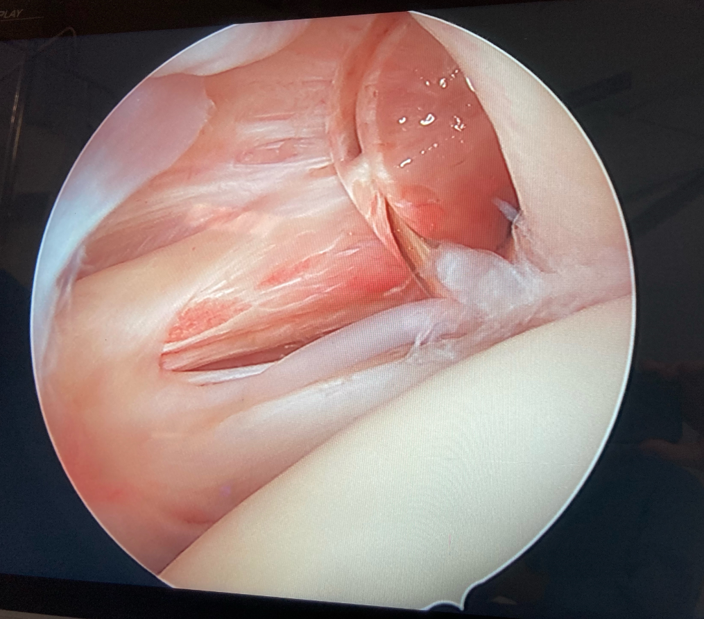 Arthroscopie d'épaule