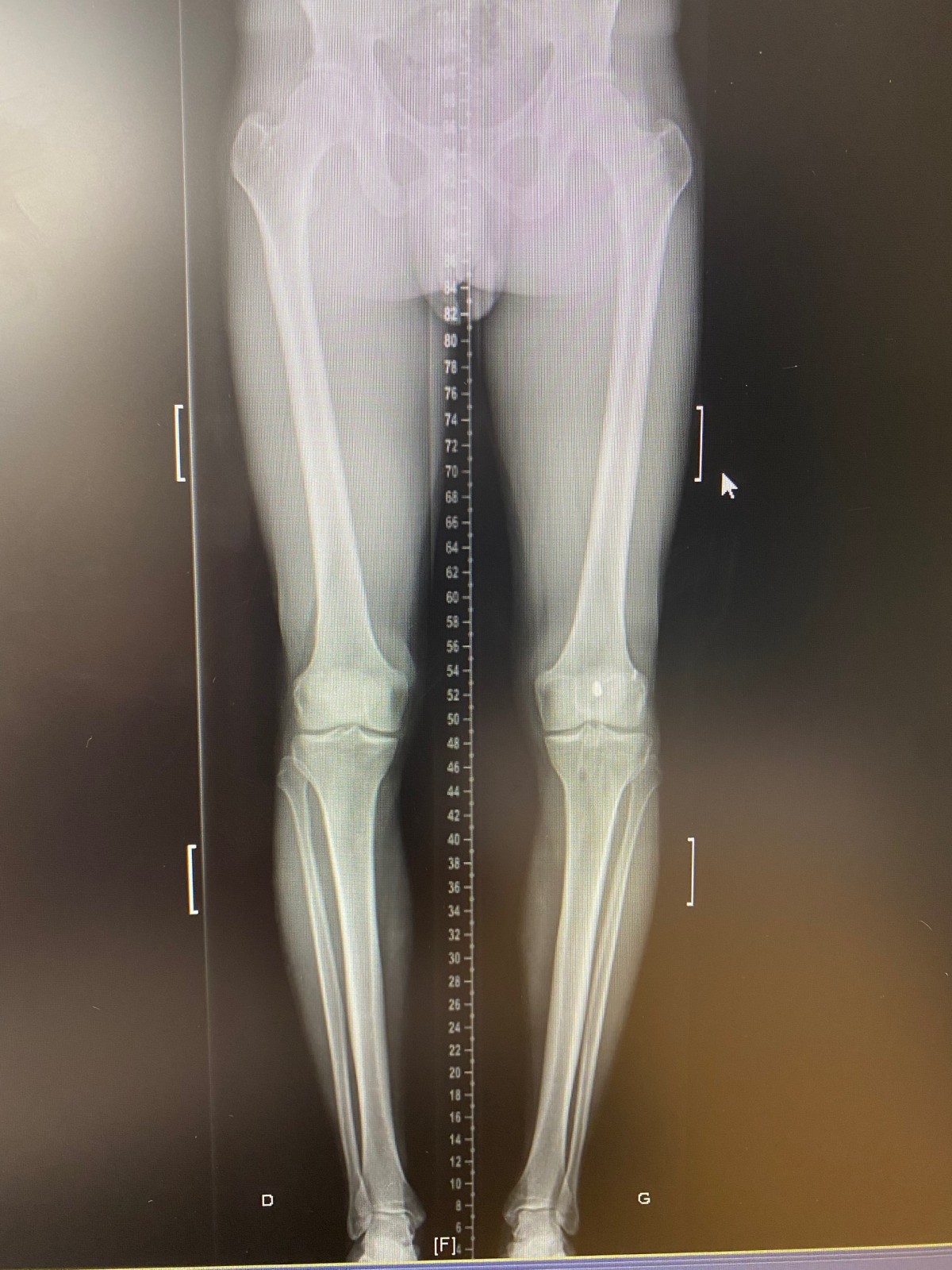 Ostéotomie Tibiale par fermeture externe pour genu Varum