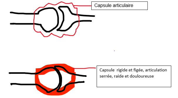 La CAPSULITE de l’Epaule : notre spécialiste de l’épaule à l’IML Marseille répond à vos questions !
