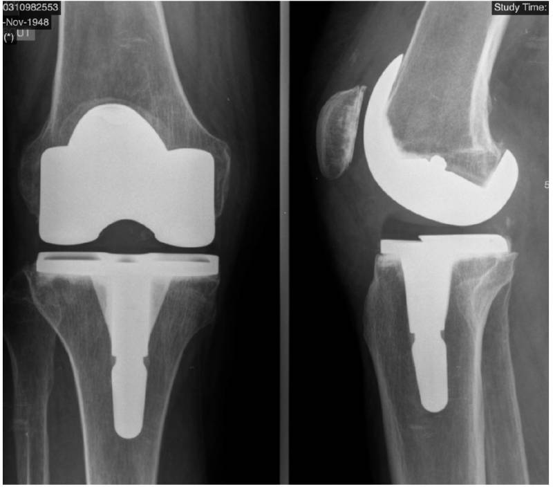 Radiographie après mise en place d'une prothèse totale du genou qui remplace les 3 articulations du genou de manière personnalisée