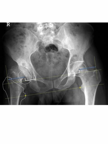 Restaurer une anatomie normale dans les arthroplasties totales de la hanche