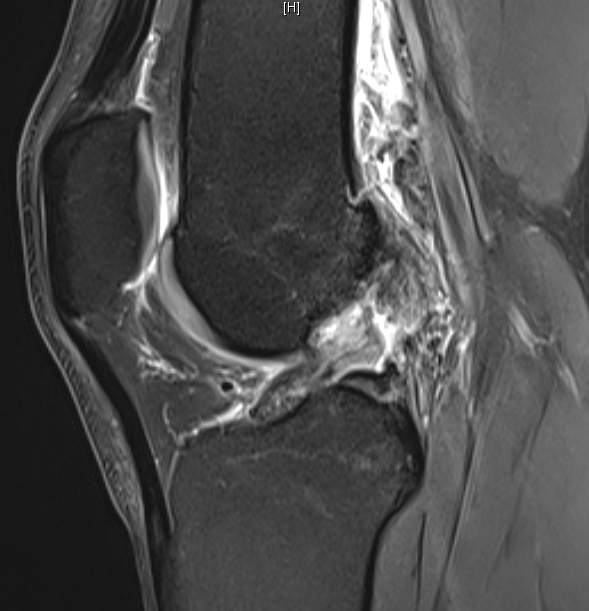 Que faire en cas de rupture du ligament croisé antérieur du genou ? Doit-on se faire opérer des ligaments croisés du genou ? Ou se faire opérer des ligaments croisés du genou à Marseille ?