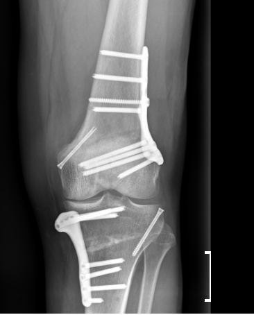 Ostéotomies du  genou : notre philosophie a l’IML marseille bouches du Rhône