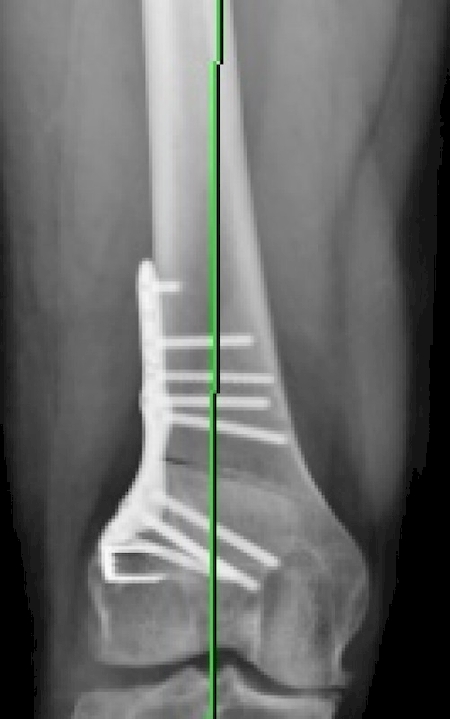 Notre zone d'activité pour ce service Réalisation de soins post opératoires au genou à Bastia en Corse